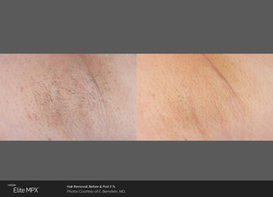 Hair Removal Madison Skin Specialists